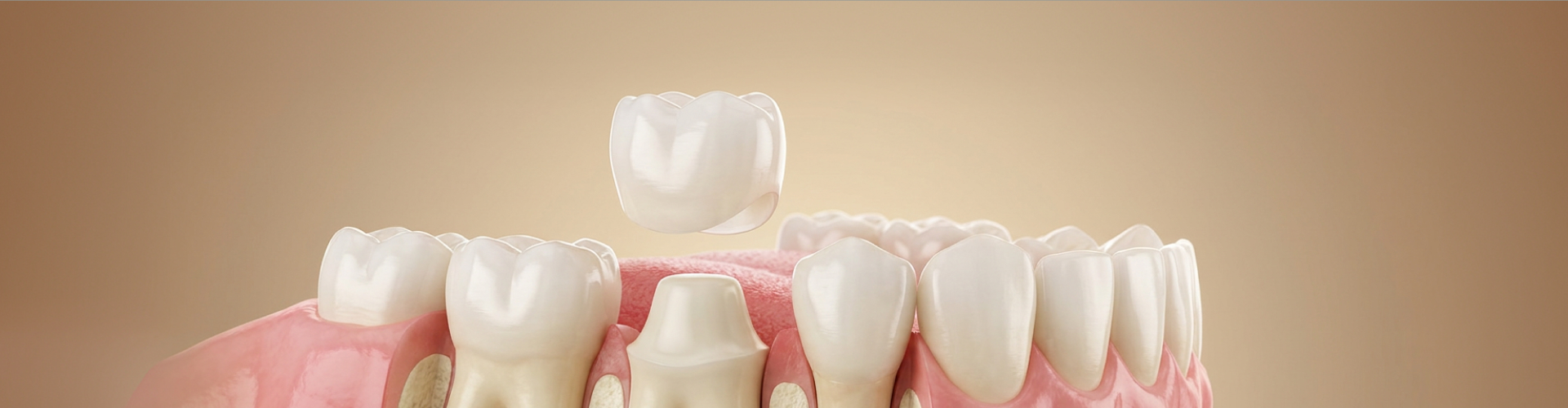 Dental illustration showing a white crown positioned above a prepared tooth, surrounded by natural teeth and pink gums.